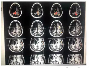 fMRI scans of brain during reflexology