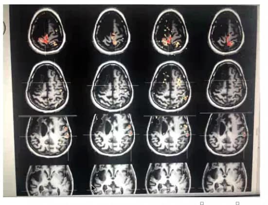 fMRI scans of brain during reflexology session